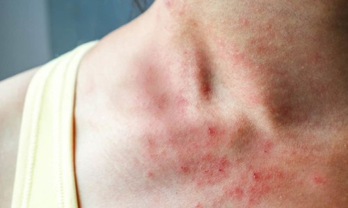 男性感染霉菌有什么危害-男人感染了霉菌的症状、男人感染了霉菌的症状 -男性染上霉菌的症状网